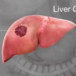 Liver cancer cases, deaths estimated to rise by over 55pc by 2040